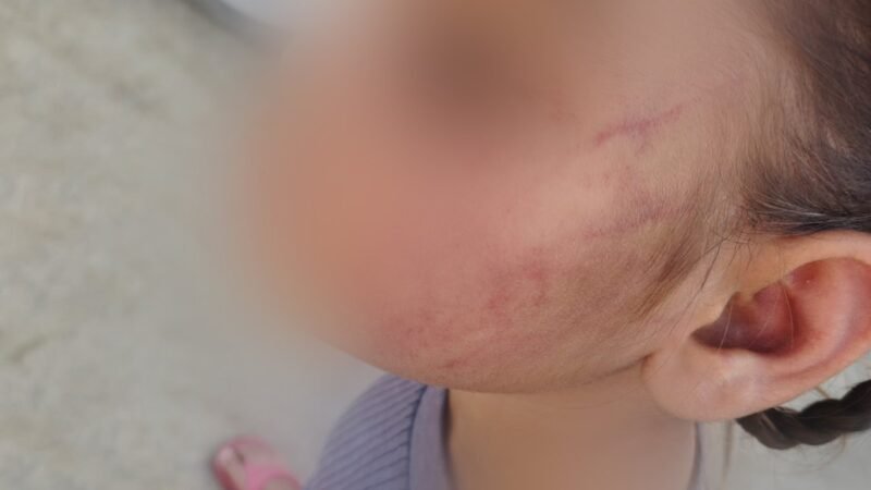 Udham Singh Nagar : शिक्षिका की बर्बरता : पांच साल की बच्ची को बुरी तरह पीटा, बेहोश हुई छात्रा – Khabar Uttarakhand